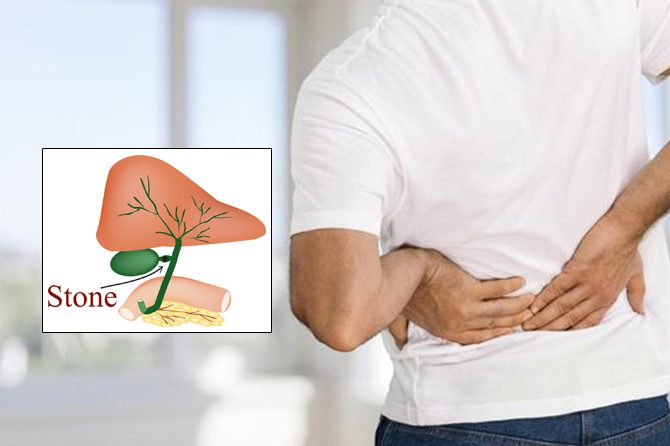 Is Gallstones Cured By Homeopathy? Symptoms, Causes, Treatment, Case Studyte