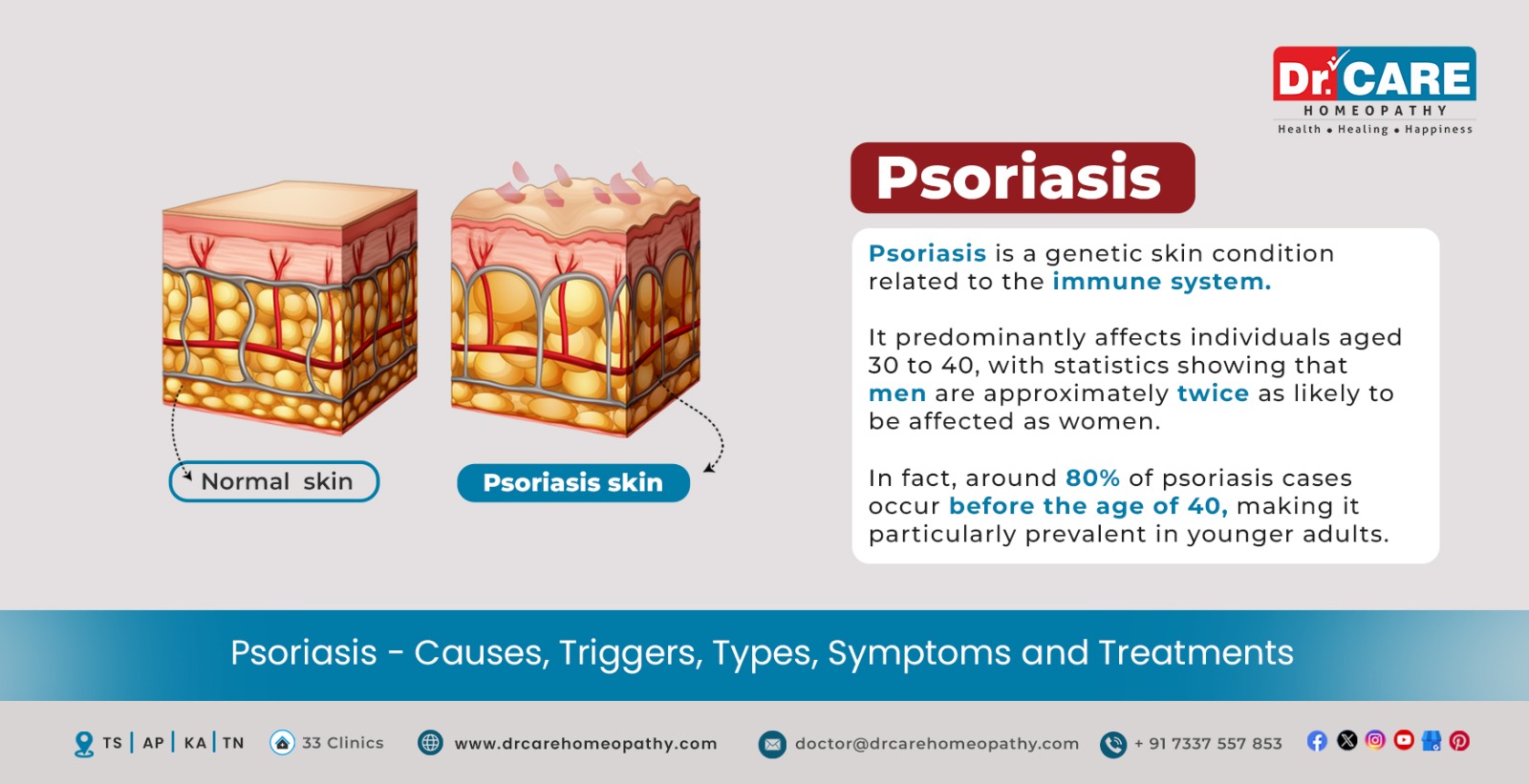 Psoriasis – Types, Symptoms, Causes, Complications And Treatment