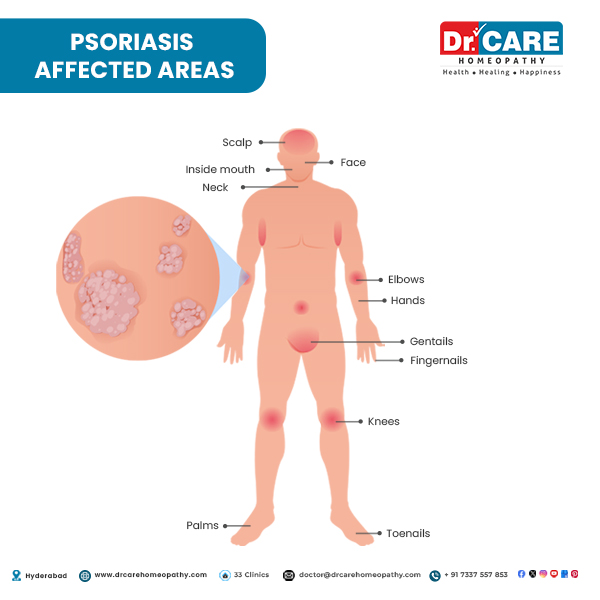 Psoriasis affected areas, Psoriasis Affected body parts