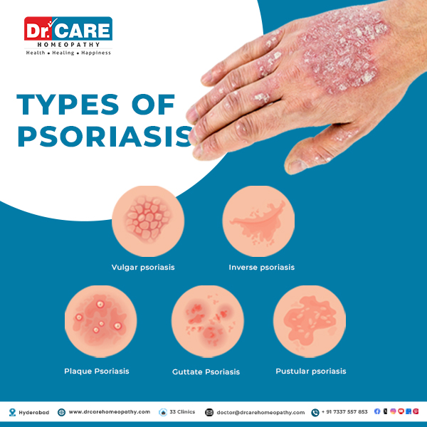 psoriasis types, different types of psoriasis