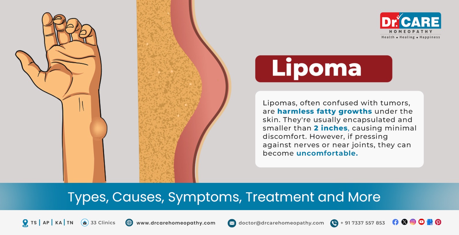 Lipoma: Types, Causes, Symptoms, Treatment, and More