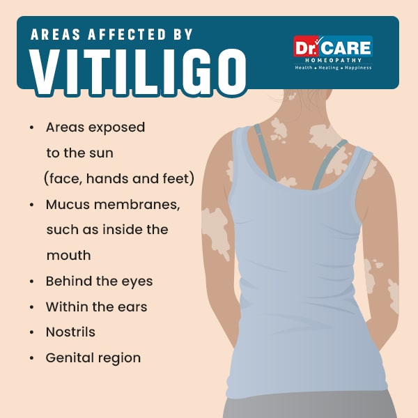 Areas affected by Vitiligo 