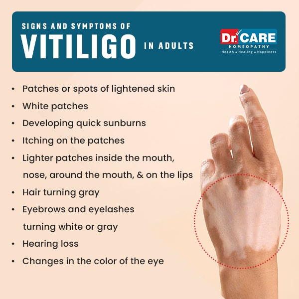 signs and symptoms of vitiligo in adults