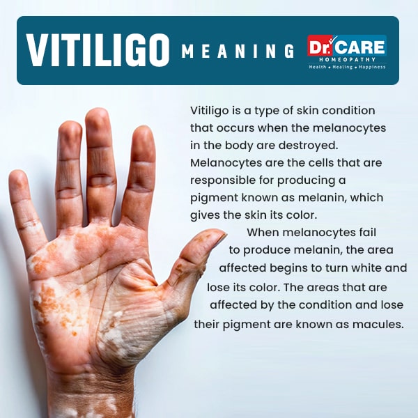 vitiligo meaning | vitiligo