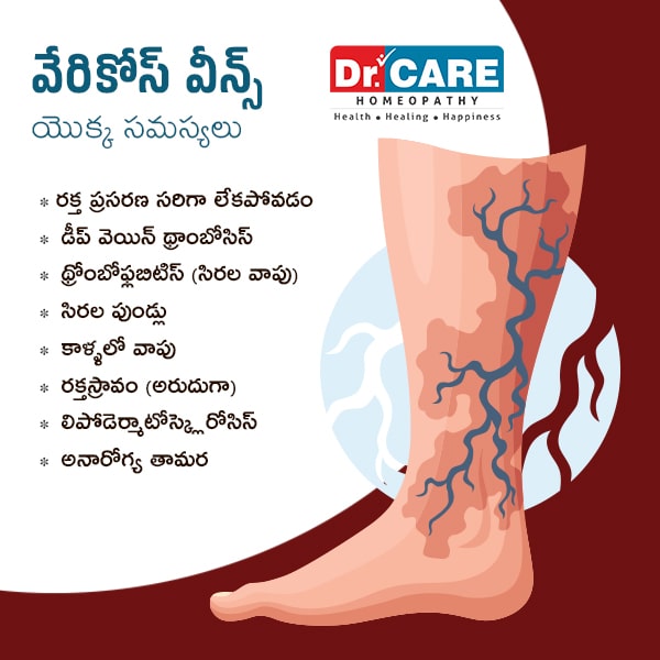 Complications of varicose veins in telugu | what is varicose veins in telugu | complication of varicose veins in telugu language