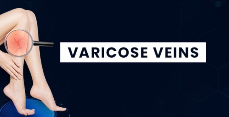 Varicose Veins-blog