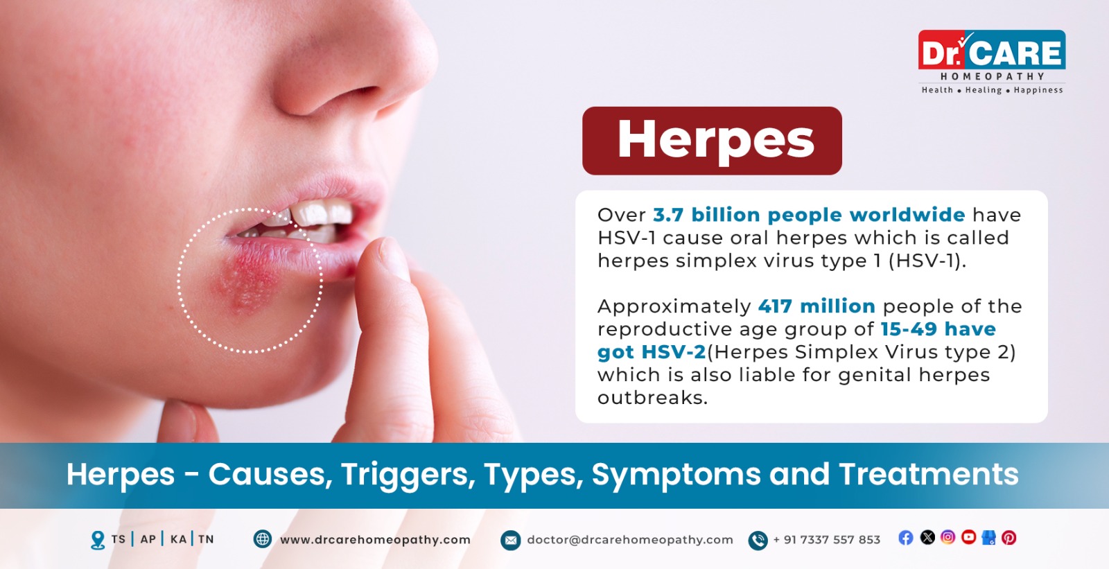Herpes – Types, Causes, Symptoms, Prevention and Treatment