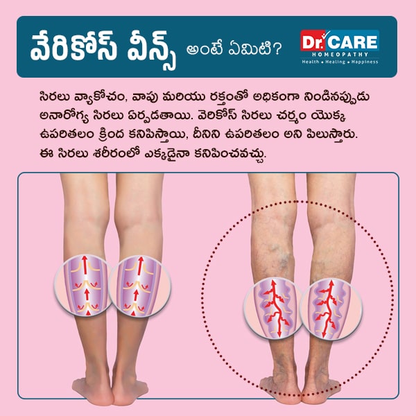 Varicose veins meaning in Telugu | varicose veins in telugu meaning| varicose veins ante emiti in telugu