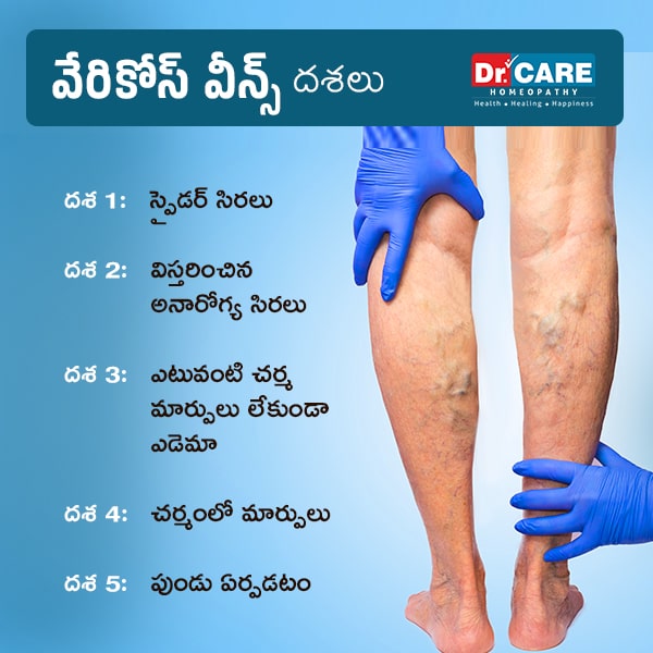 varicose veins stages in telugu | varicose veins dasalu in telugu |varicose veins meaning in telugu