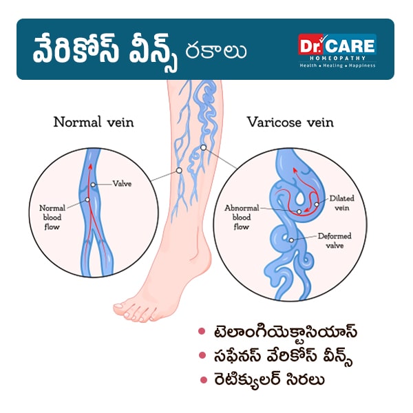 varicose veins telugu lo | varicose veins types in telugu | varicose veins rakalu in telugu