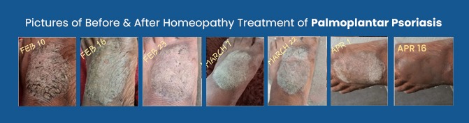 Homeopathy Treatments For Psoriasis