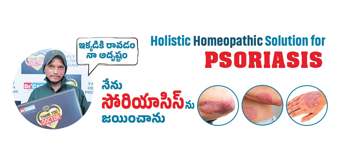 Homeopathy-Treatment-for-psoriasis