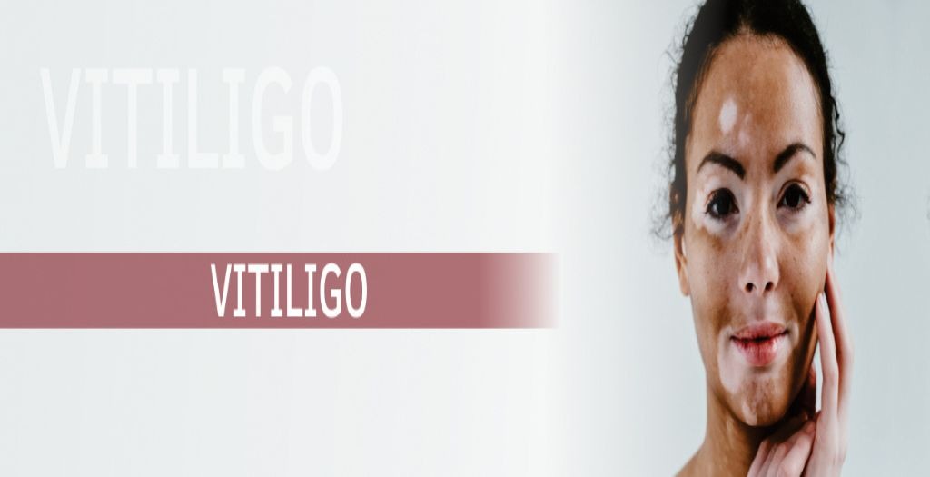 Vitiligo-blog