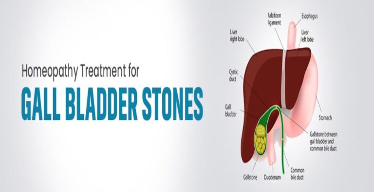 gall-bladder-stones