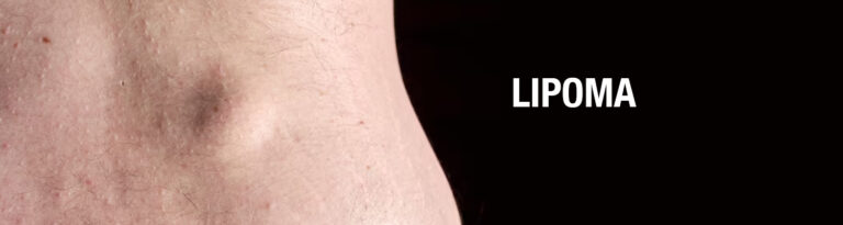 లిపోమా