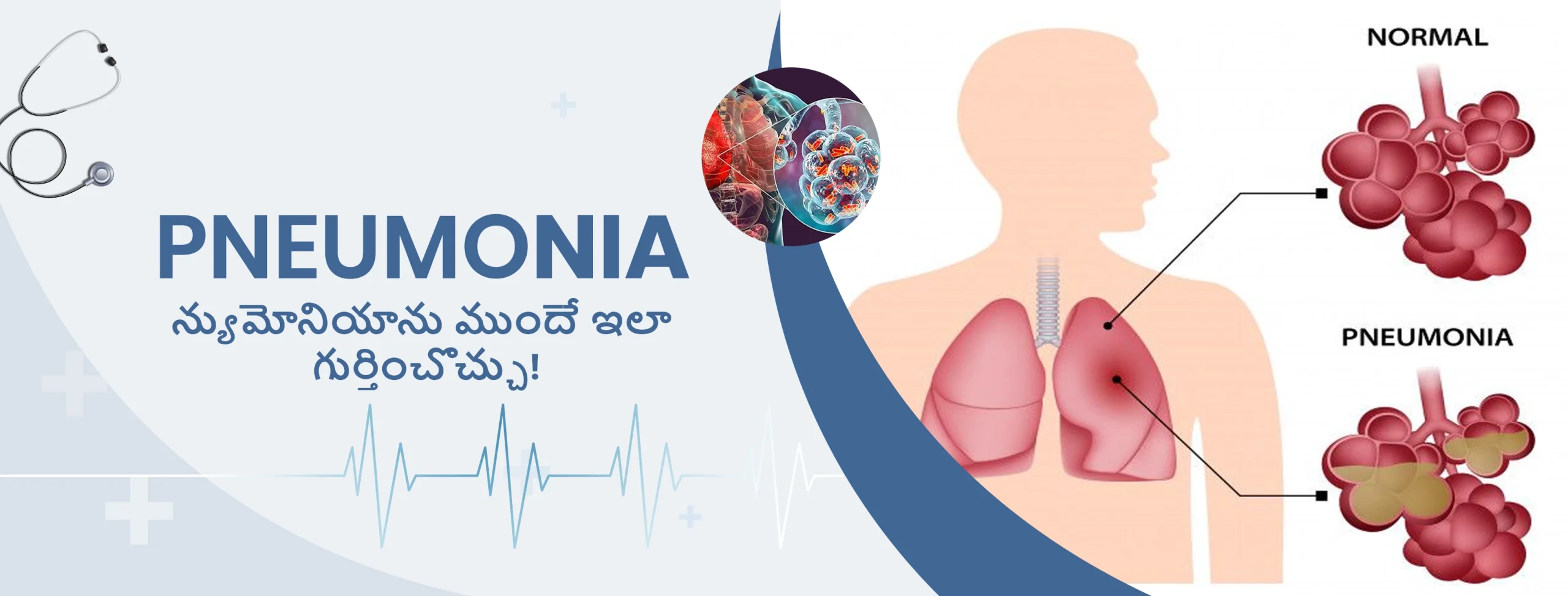 న్యుమోనియాను ముందే ఇలా గుర్తించొచ్చు!