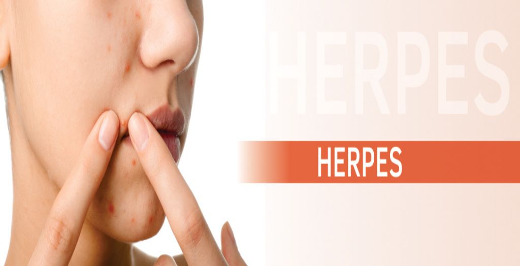 Blog 27 herpes-blog