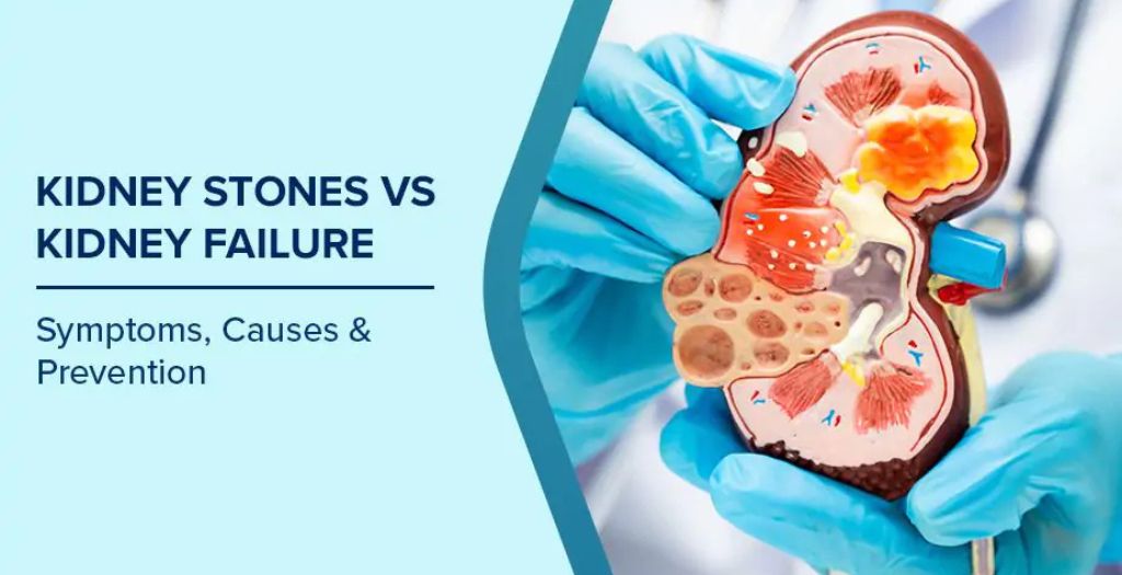 Blog 24 kidney-stones-blog