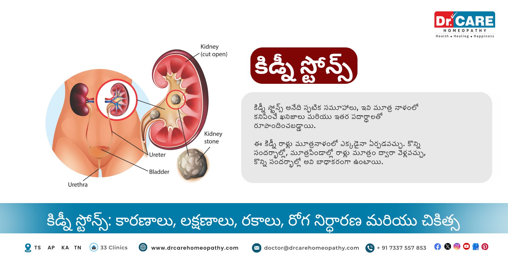 కిడ్నీ స్టోన్స్: కారణాలు, లక్షణాలు, రకాలు, రోగ నిర్ధారణ మరియు చికిత్స