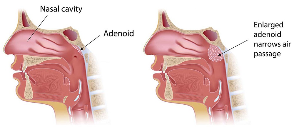 Blog 14 adenoidectomy illustration c9ca65 1
