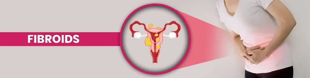 Homeopathic-Treatment-for-Fibroids