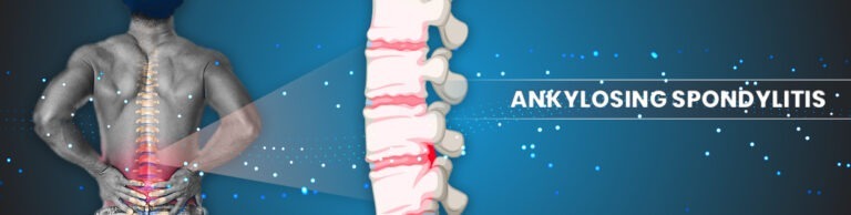 Best Homeopathy Treatment of Ankylosing Spondylitis