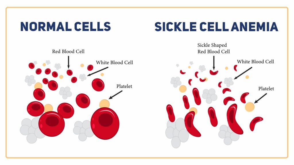 Sickle-cell-anemia