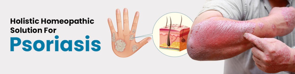 psoriasis-homeopathy-treatment