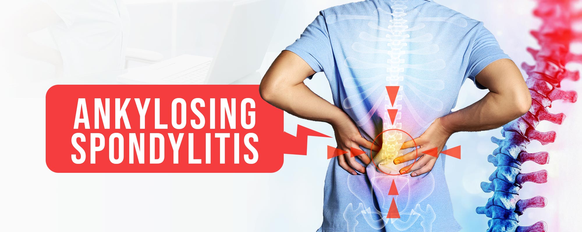 Ankylosing Spondylitis Treatments