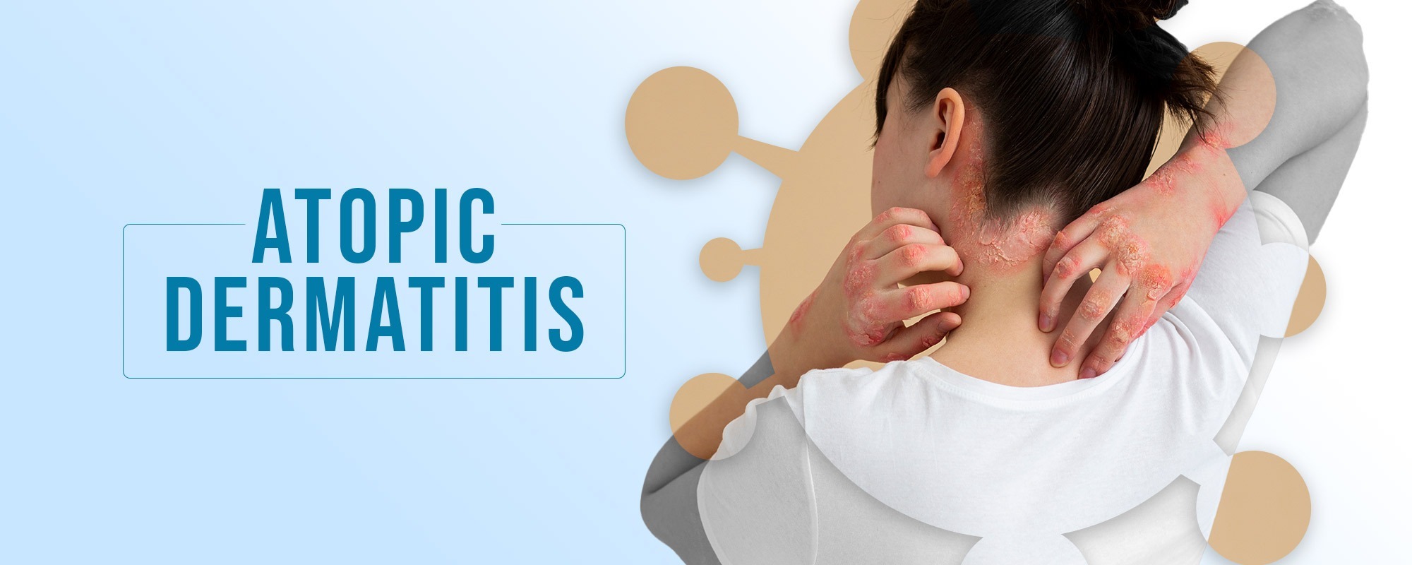 Atopic Dermatitis TreatmentsBanner 2000X800