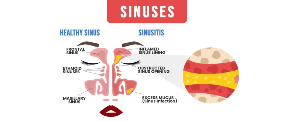 Best-Homeopathy-Treatment-for-Sinusitis-and-Allergic-Rhinitis-in-Hyderabad