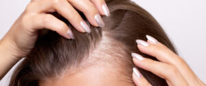 Homeopathy Treatment for Hair Fall: Causes, Symptoms, and Natural Solutions 3 Hair fall symtoms