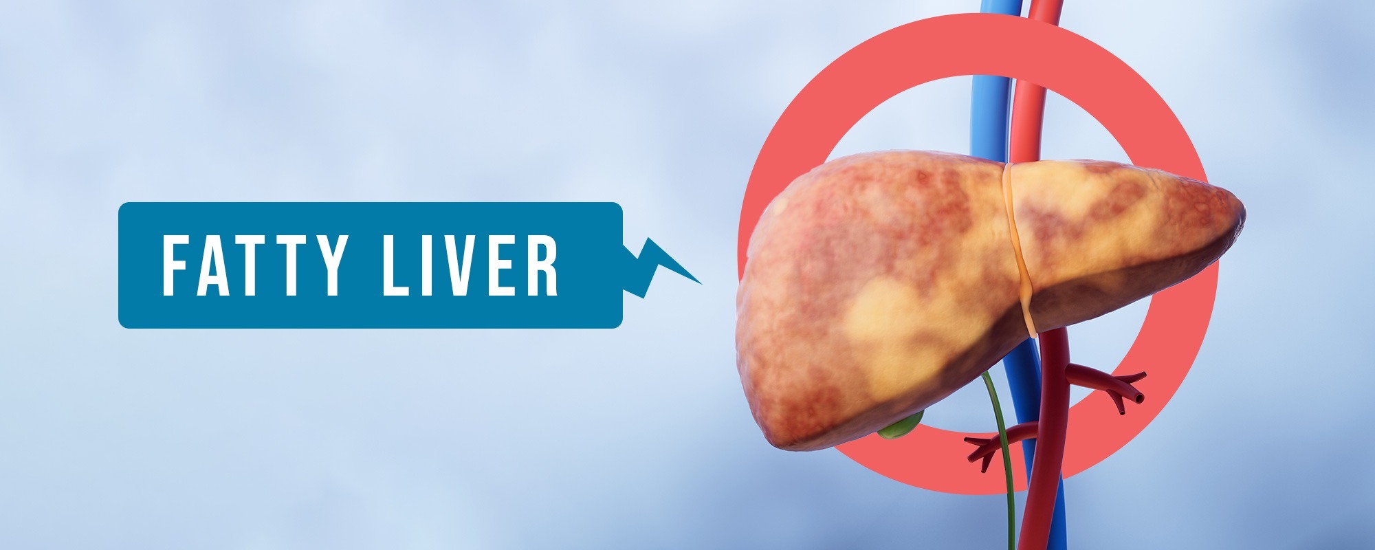 Fatty Liver Treatments 1