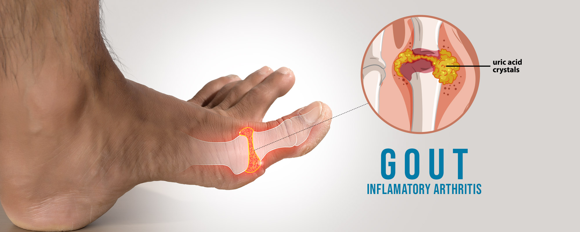 Gout Treatments 1