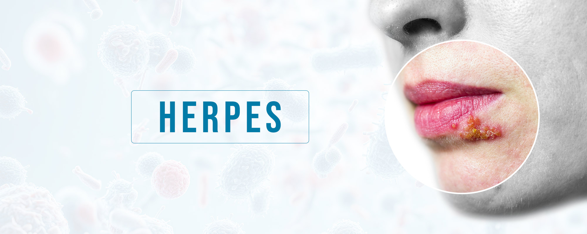 Herpes TreatmentsBanner 2000X800