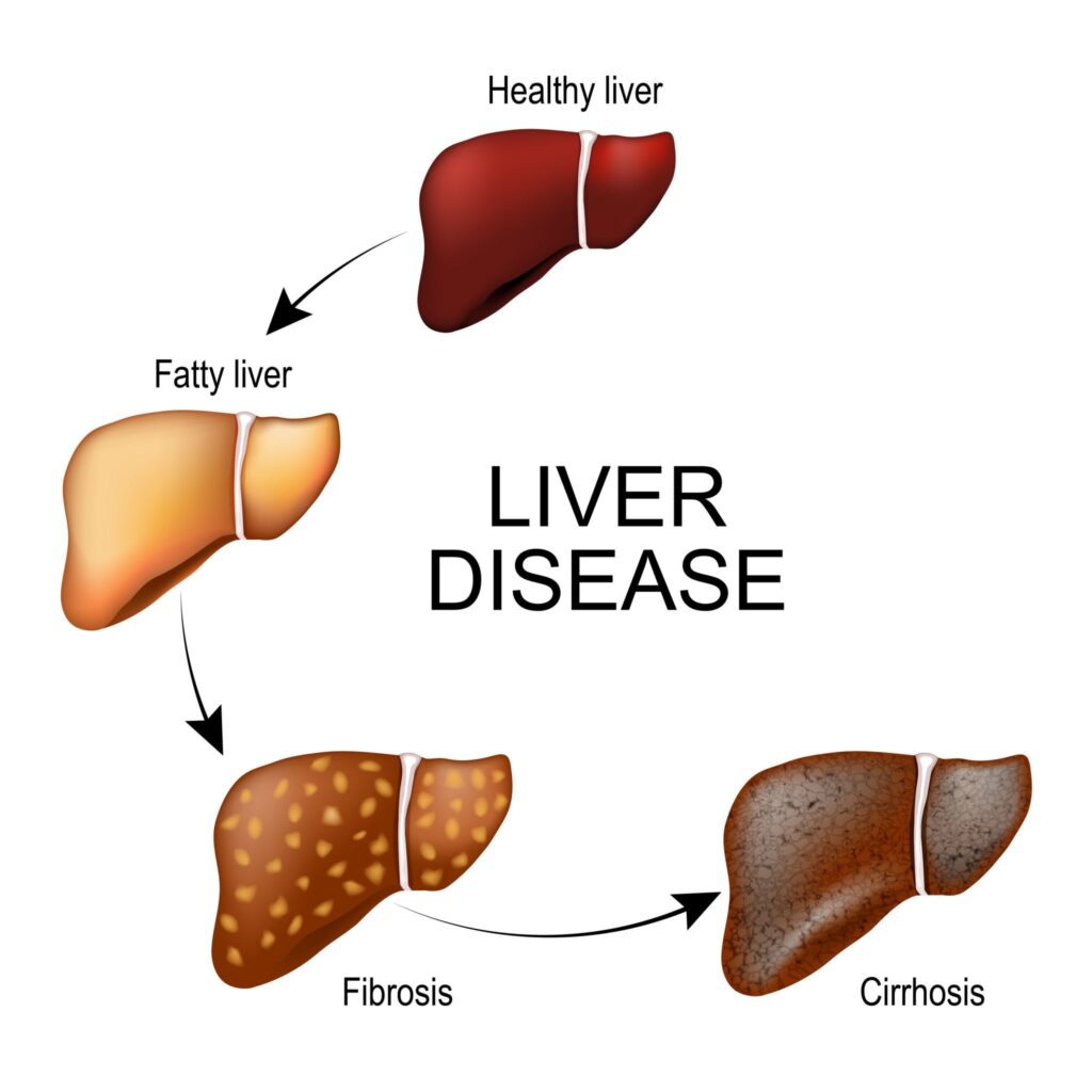 What is fatty liver disease