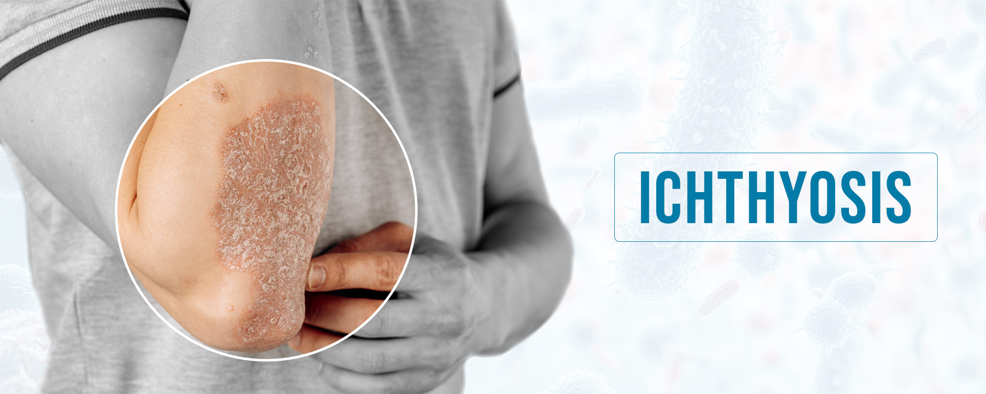 Ichthyosis TreatmentsBanner 2000X800