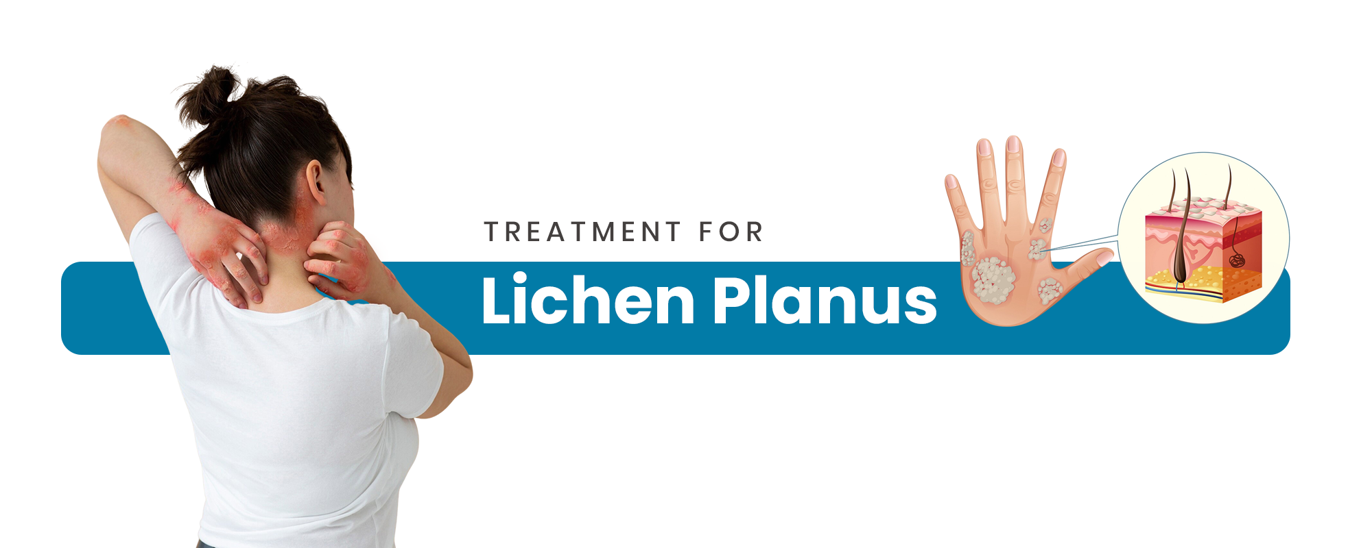 Lichen Planus