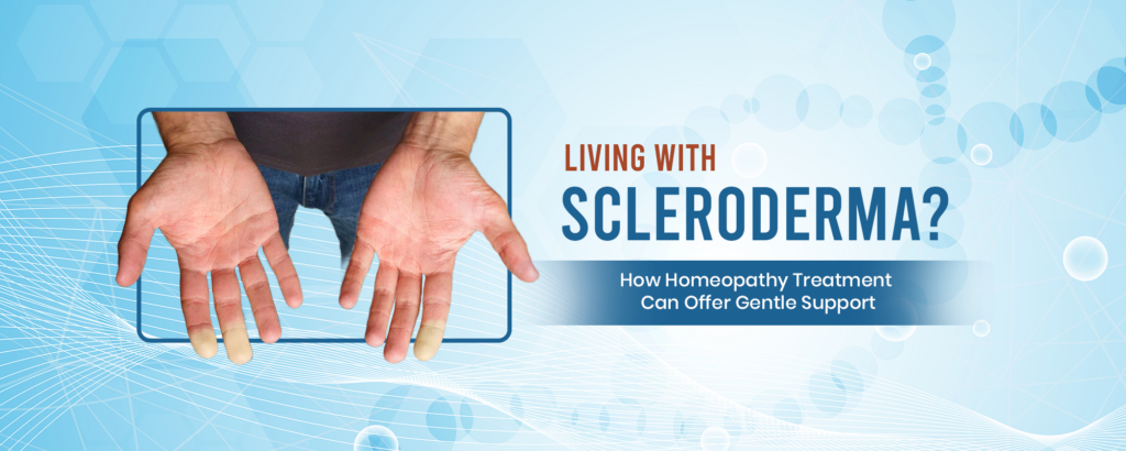 Scleroderma Treatment with Homeopathy