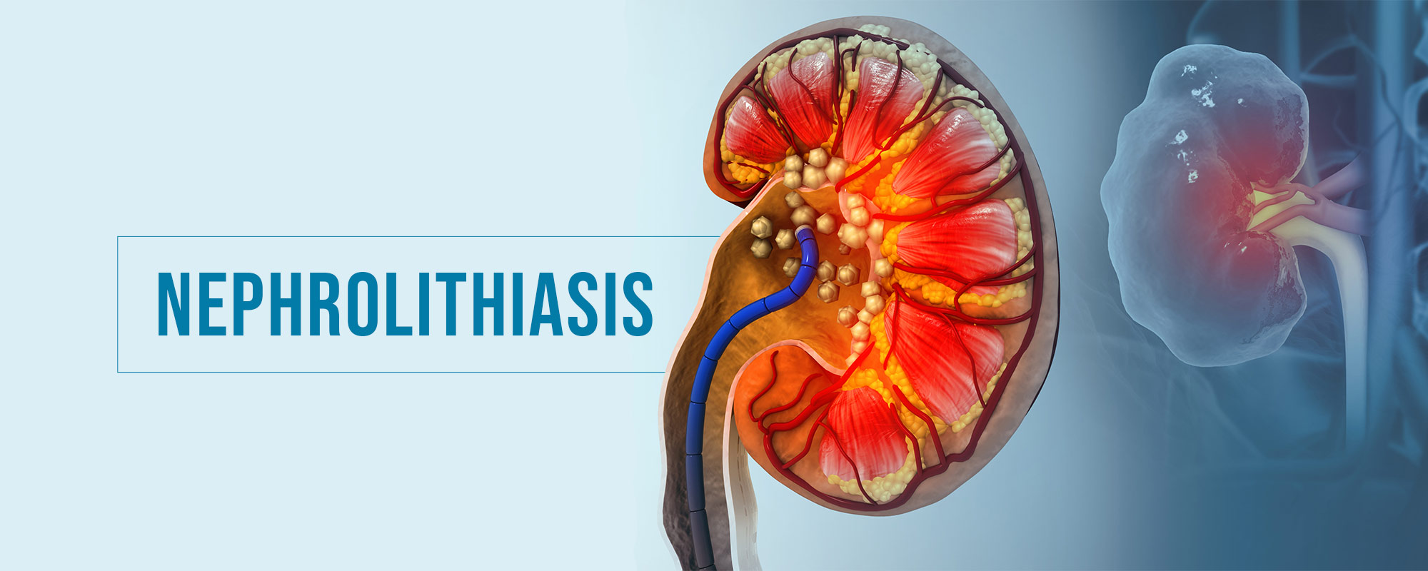 Nephrolithiasis Treatments