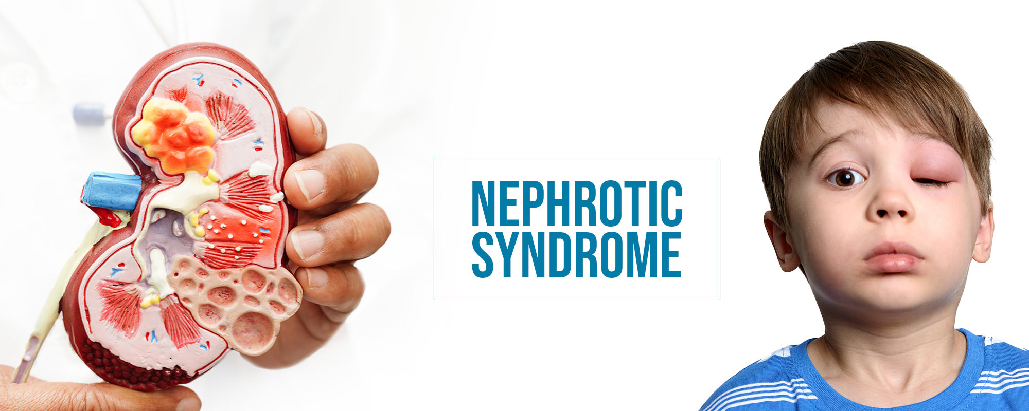 Nephrotic Syndrome Treatments