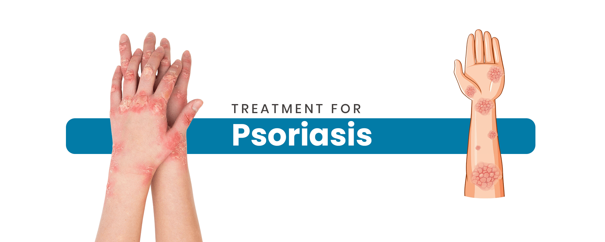 Psoriasis