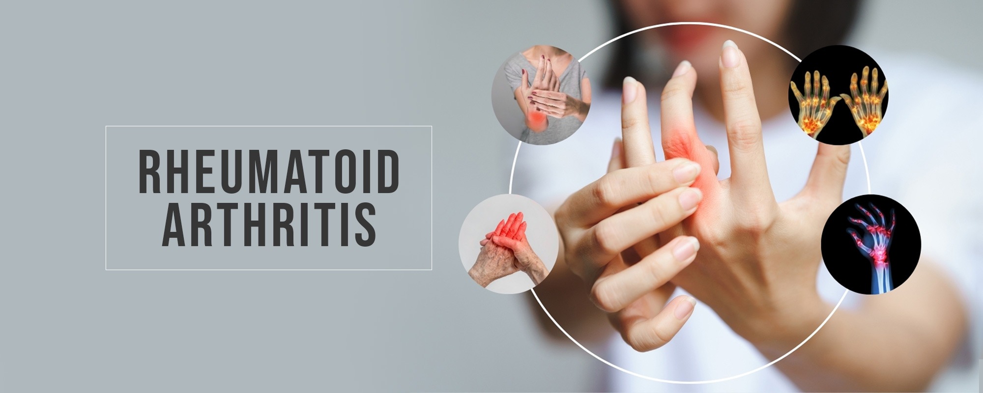 Rheumatoid Arthritis Treatments