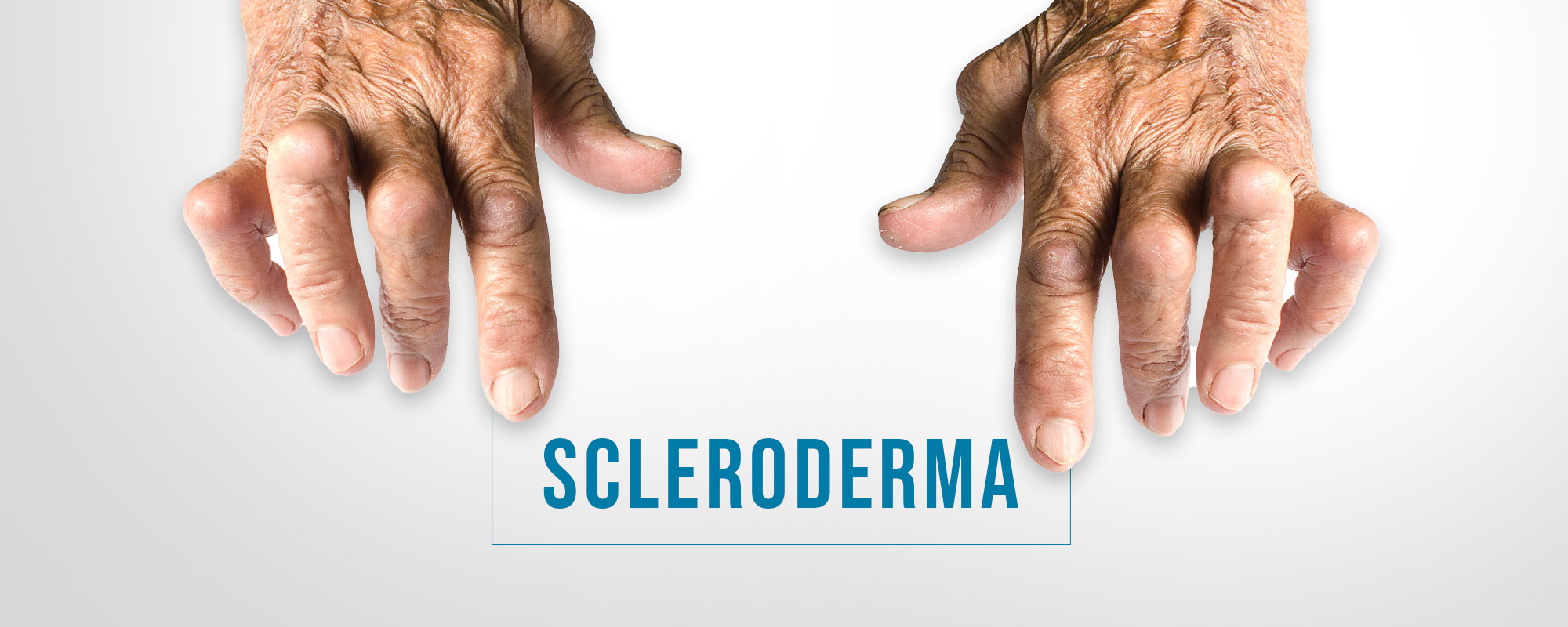 Scleroderma Treatments