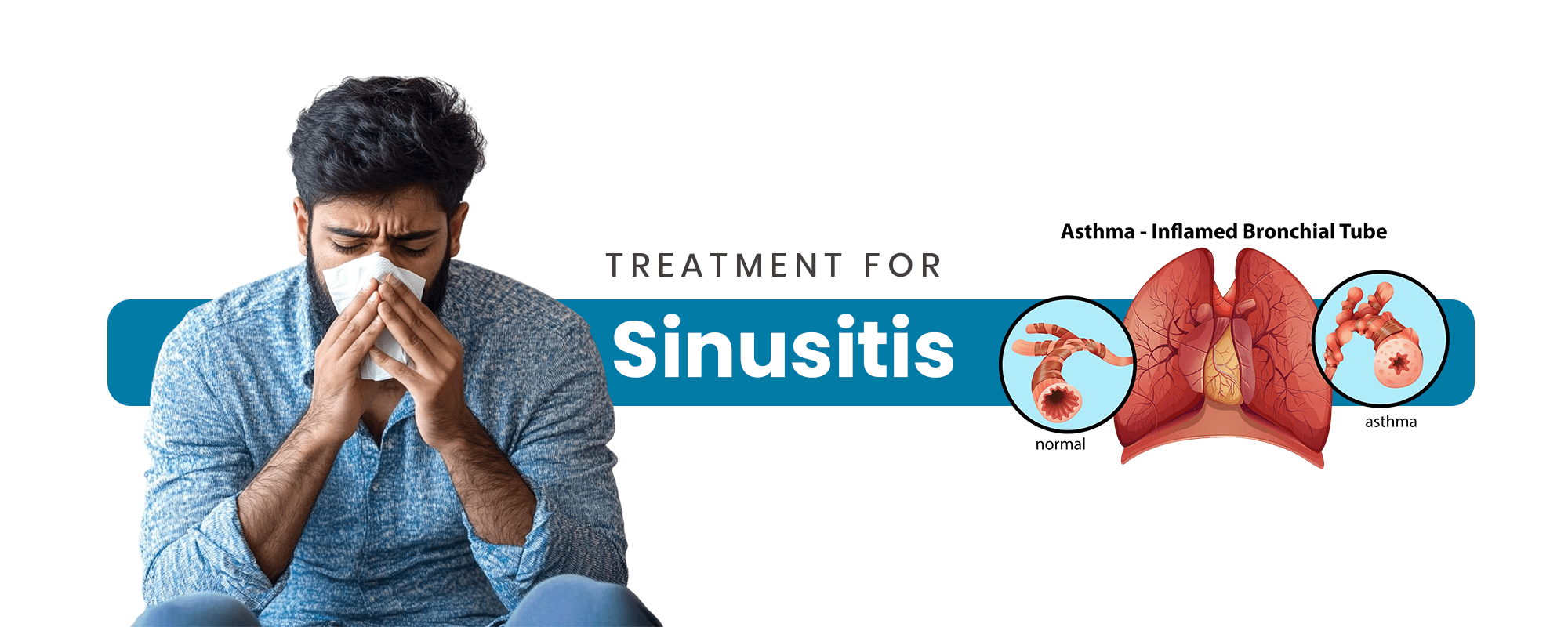 Sinusitis