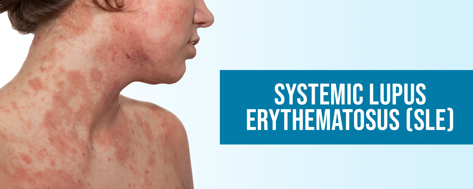 Systemic Lupus Erythematosus SLE Treatments