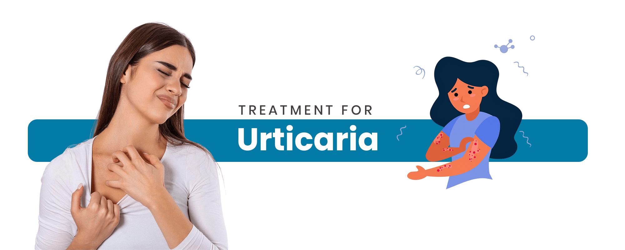 Urticaria