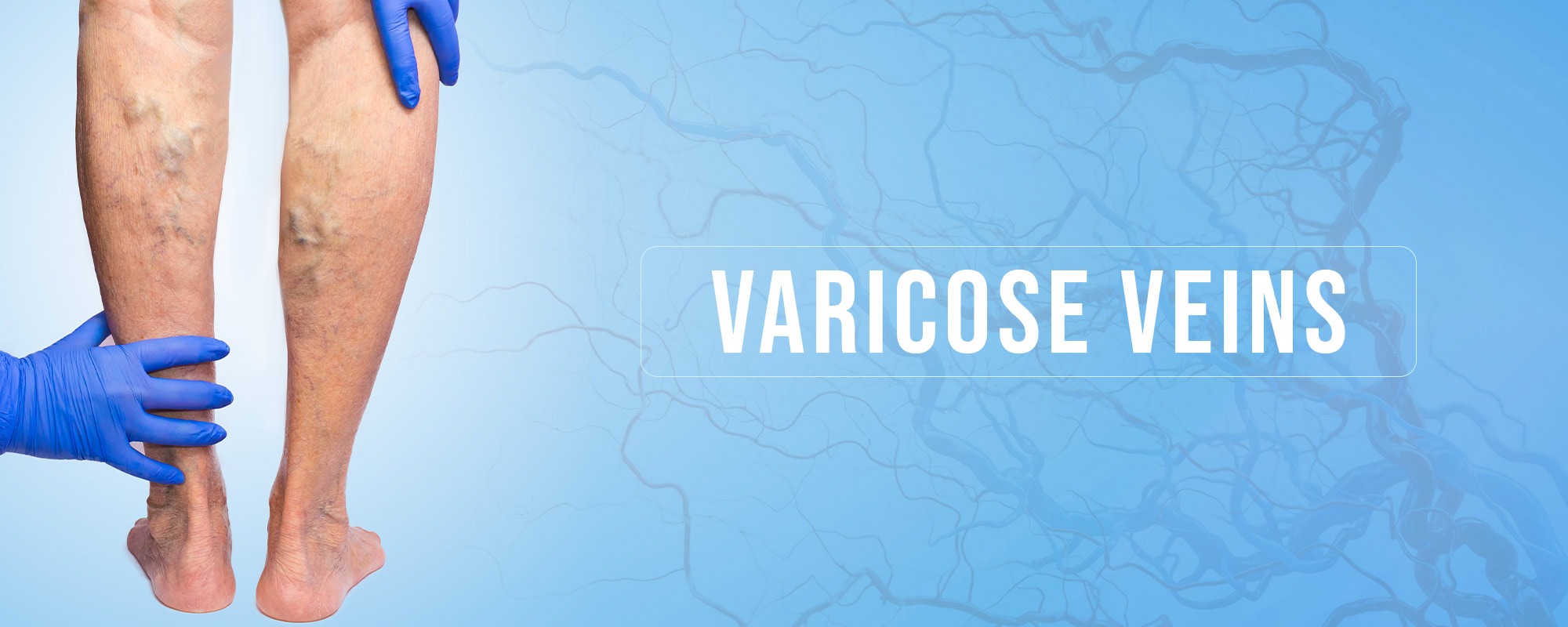 Varicose Veins TreatmentsBanner 2000X800