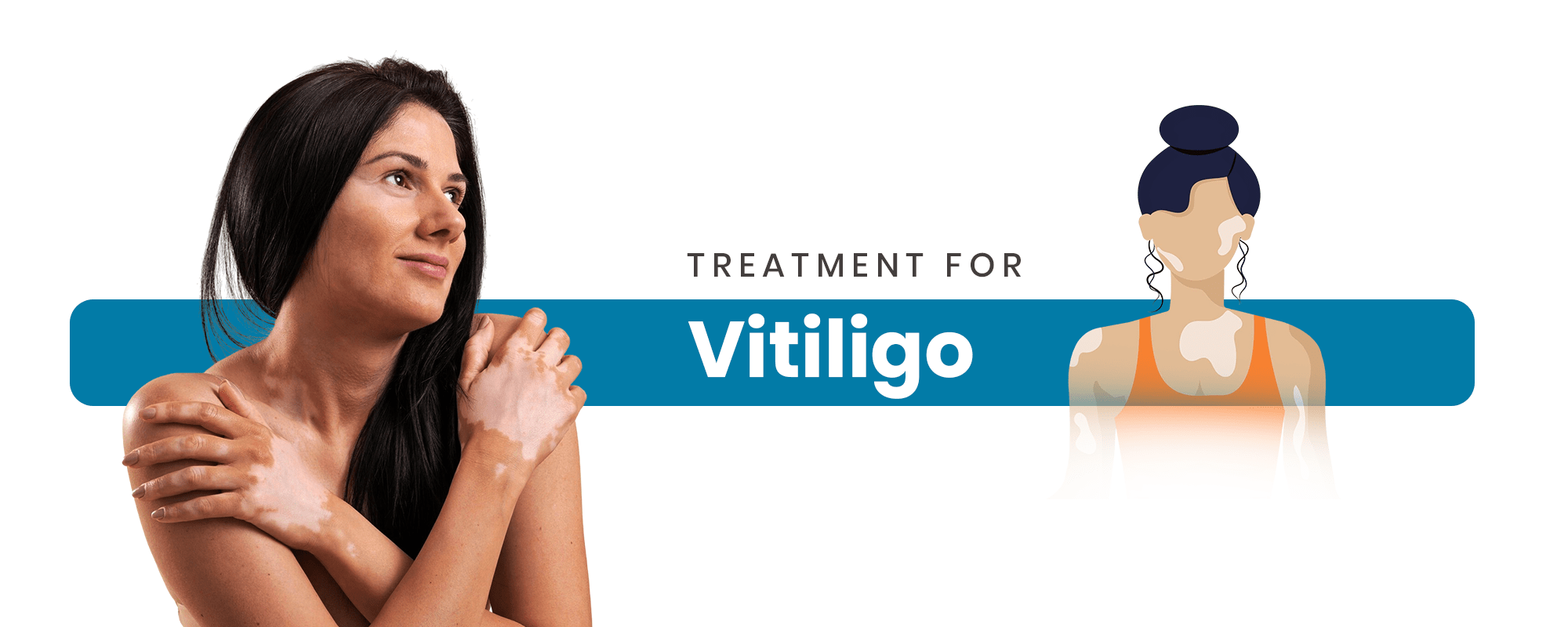 Vitiligo
