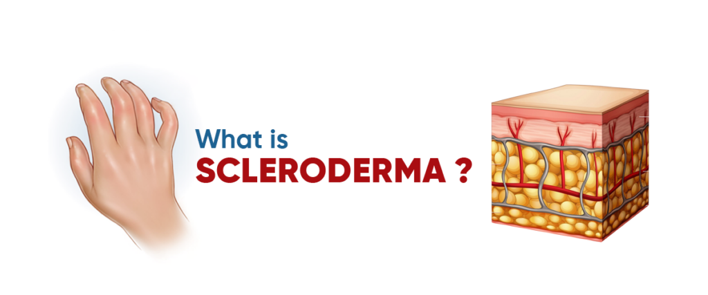 What is scleroderma